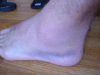 Slightly bruised